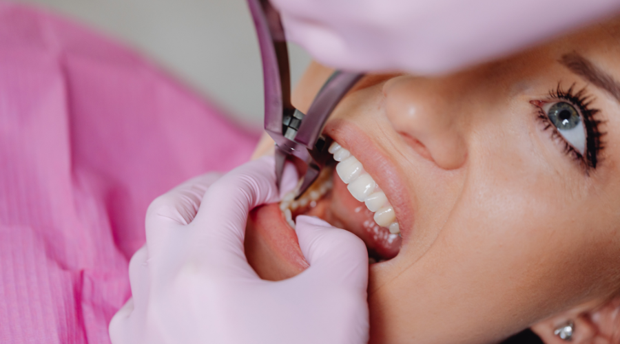 Common Questions About Dental Implants