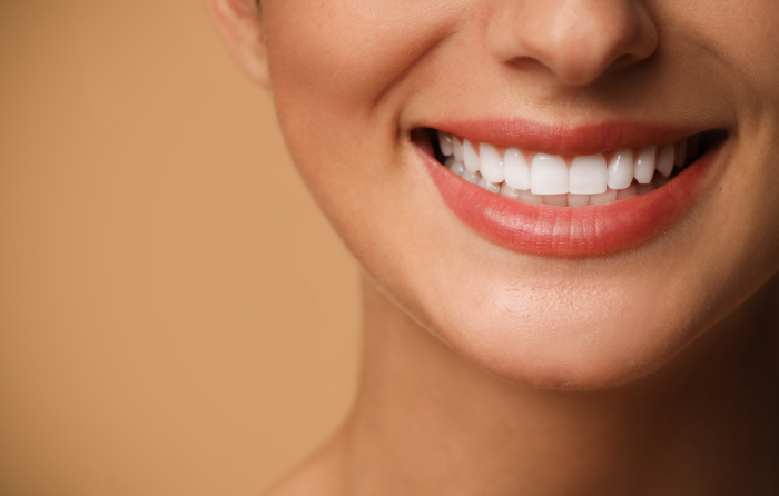 What Are Dental Veneers