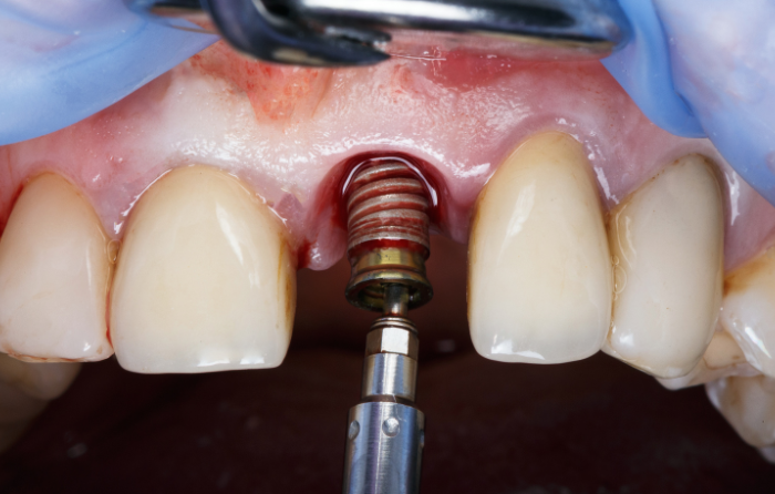 Why Dental Implants Are a Long-Term Solution for Missing Teeth